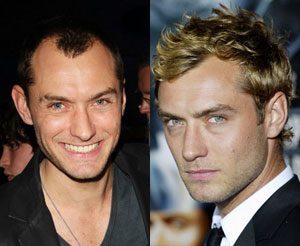 Jude Law Hair Transplant | Hold the Hairline