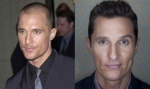 Matthew Mcconaughey Hair Transplant