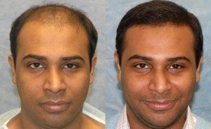 Successful Hair Transplant Surgery