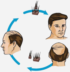 Hair Transplants Permanent Hair Loss Treatment