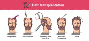 Hair transplantation chart